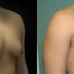Male Breast reduction surgery