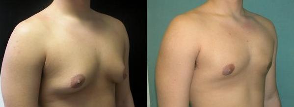 Male Breast reduction surgery