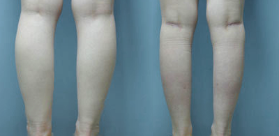 leg-liposuction