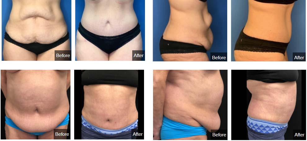 Calorie Requirement After Tummy Tuck