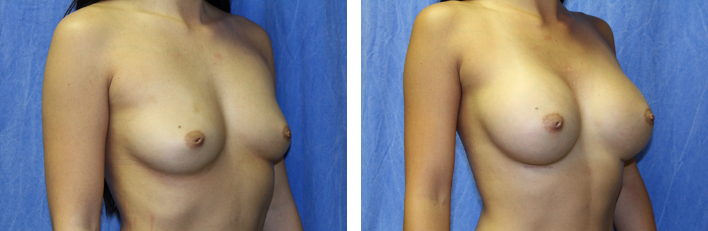 breast augmentation birmingham mi