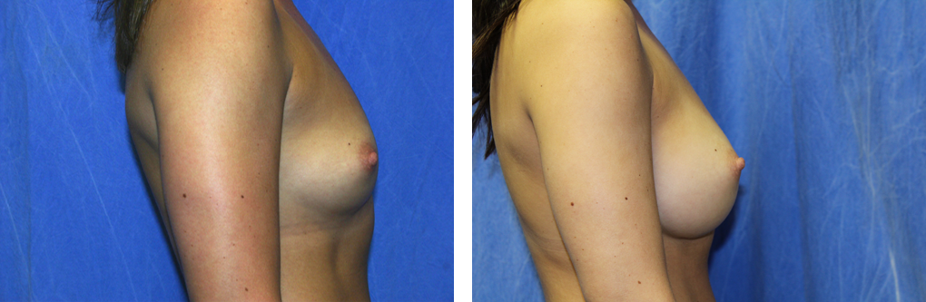 breast augmentation birmingham mi