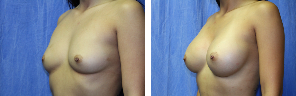 breast implants birmingham mi