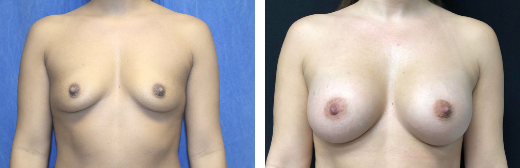 breast implants birmingham mi