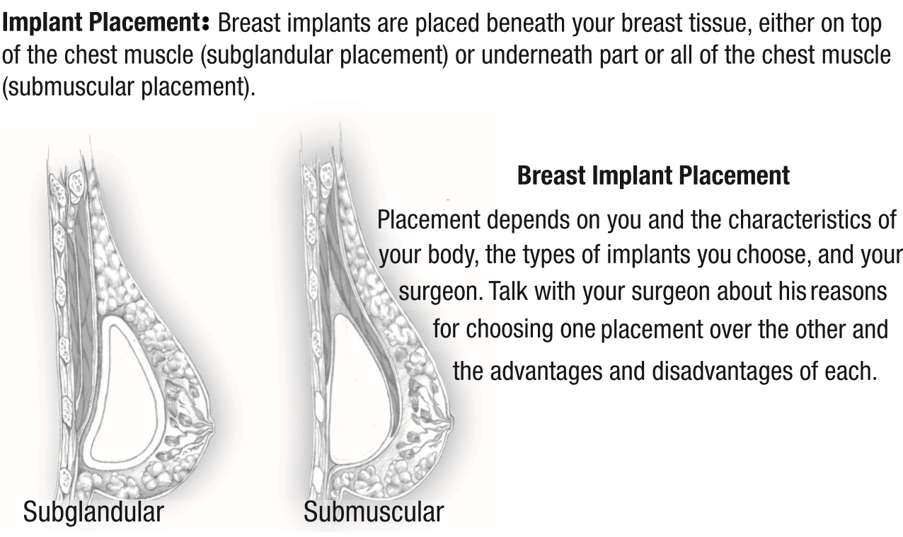 breast implant surgeon detroit