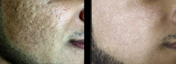 laser acne scar removal