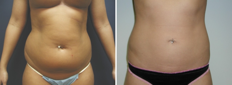 liposuction before & after