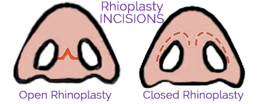 rhinoplasty surgery birmingham mi