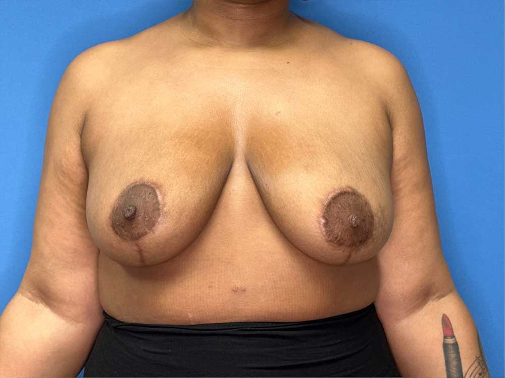 breast reduction surgery after