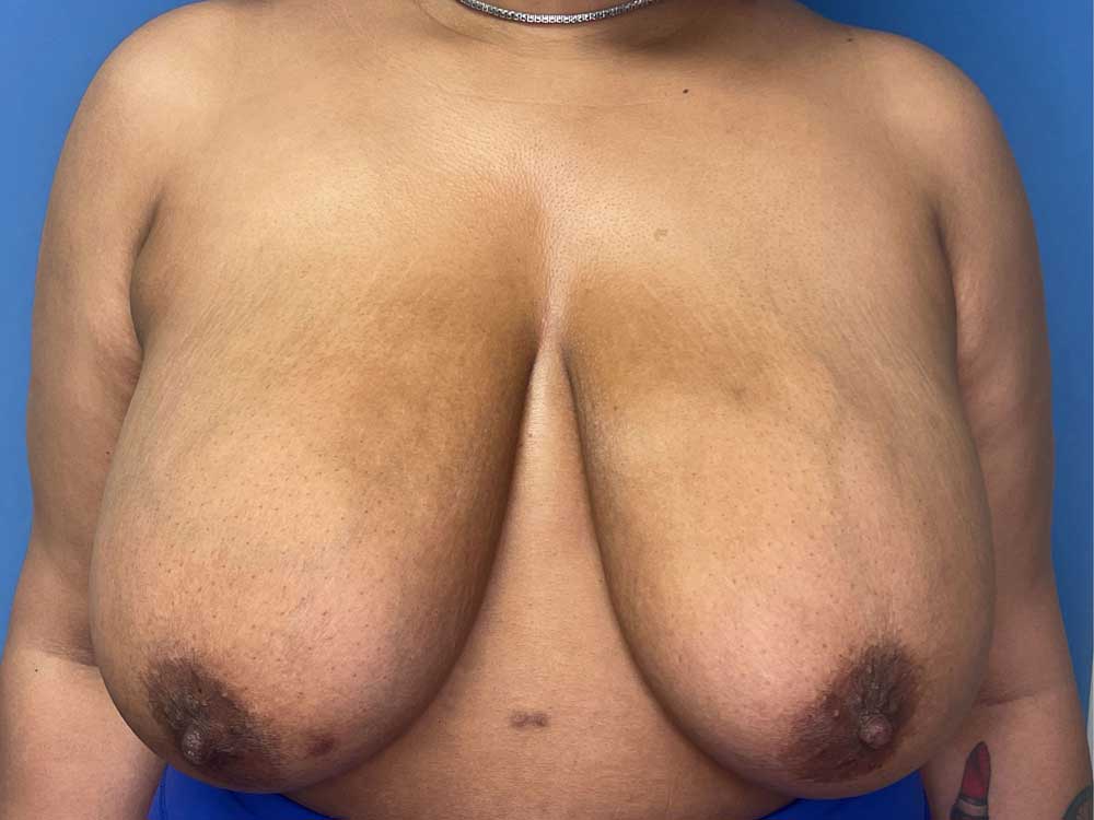 breast reduction surgery before