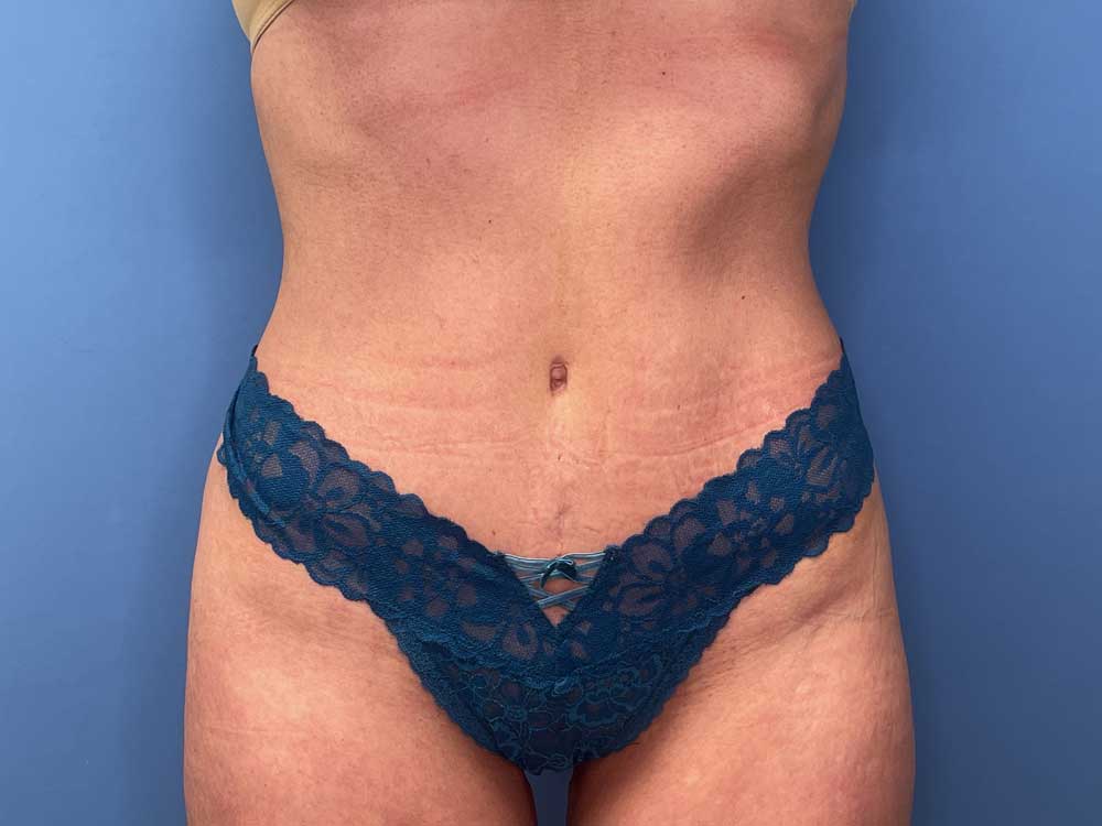 Tummy Tuck After
