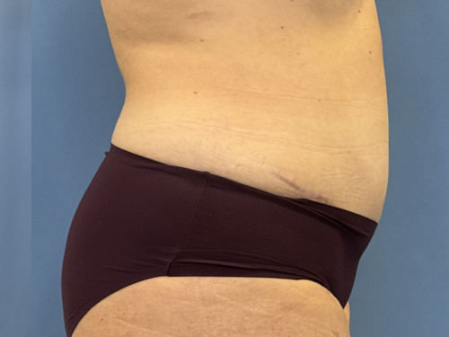 Tummy Tuck Surgery After