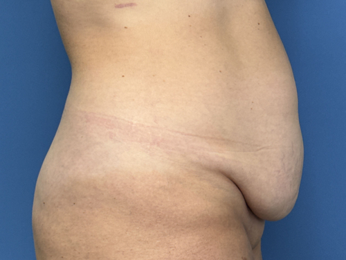 Tummy Tuck Surgery Before