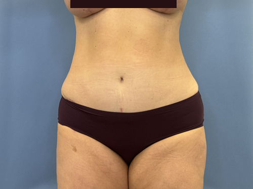 Tummy Tuck Surgery After