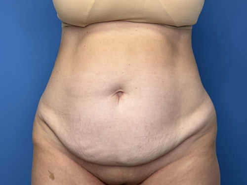 Tummy Tuck Surgery Before