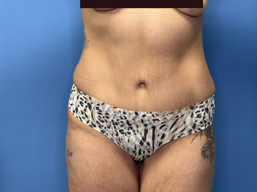 Tummy Tuck Surgery After