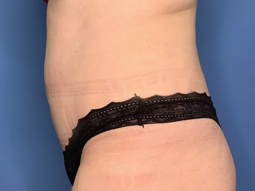 Tummy Tuck Surgery After