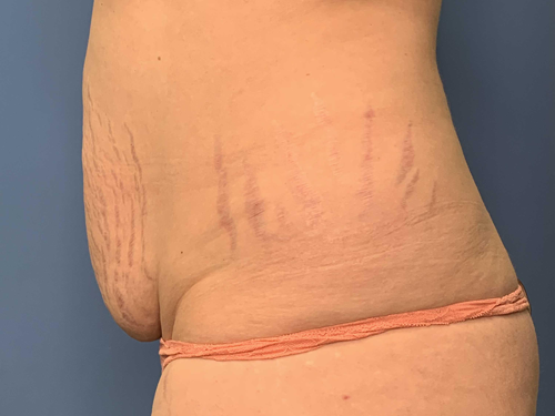 Tummy Tuck Surgery Before