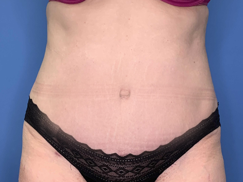 Tummy Tuck Surgery After