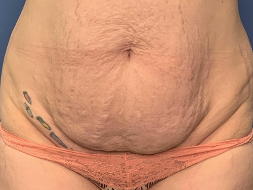 Tummy Tuck Surgery Before